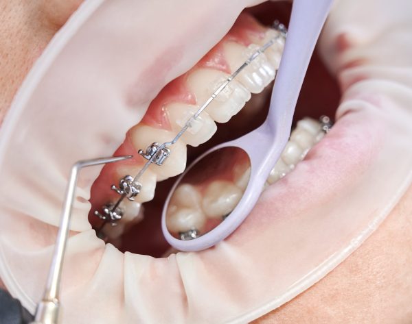 Close up of orthodontist using cofferdam and dental instruments while placing orthodontic brackets on patient teeth. Concept of stomatology, dentistry and orthodontic treatment.