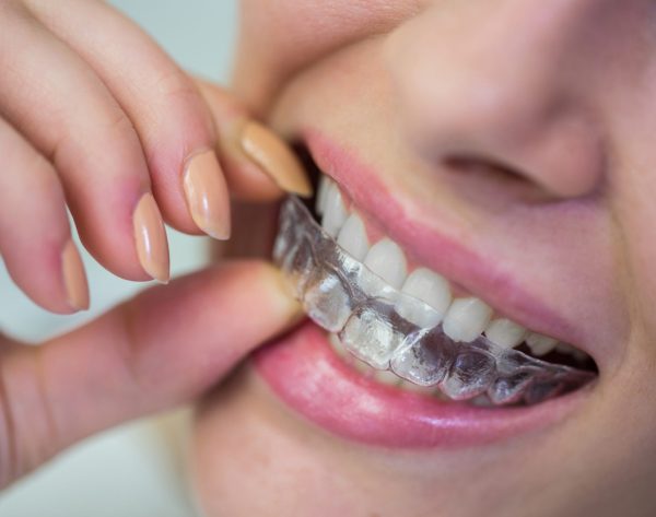 Close-up of woman wearing orthodontic silicone invisible braces